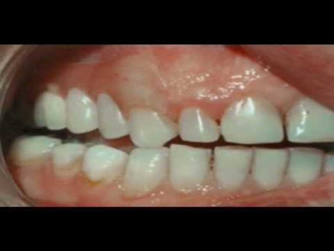 Immediate Dentures Procedure Brunswick ME 4011